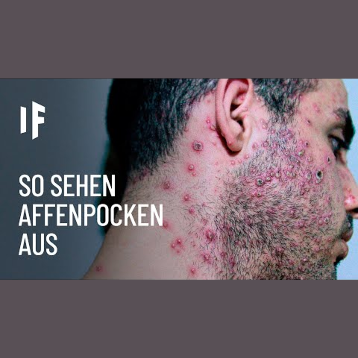 Was wäre, wenn man sich mit Affenpocken infiziert episode artwork