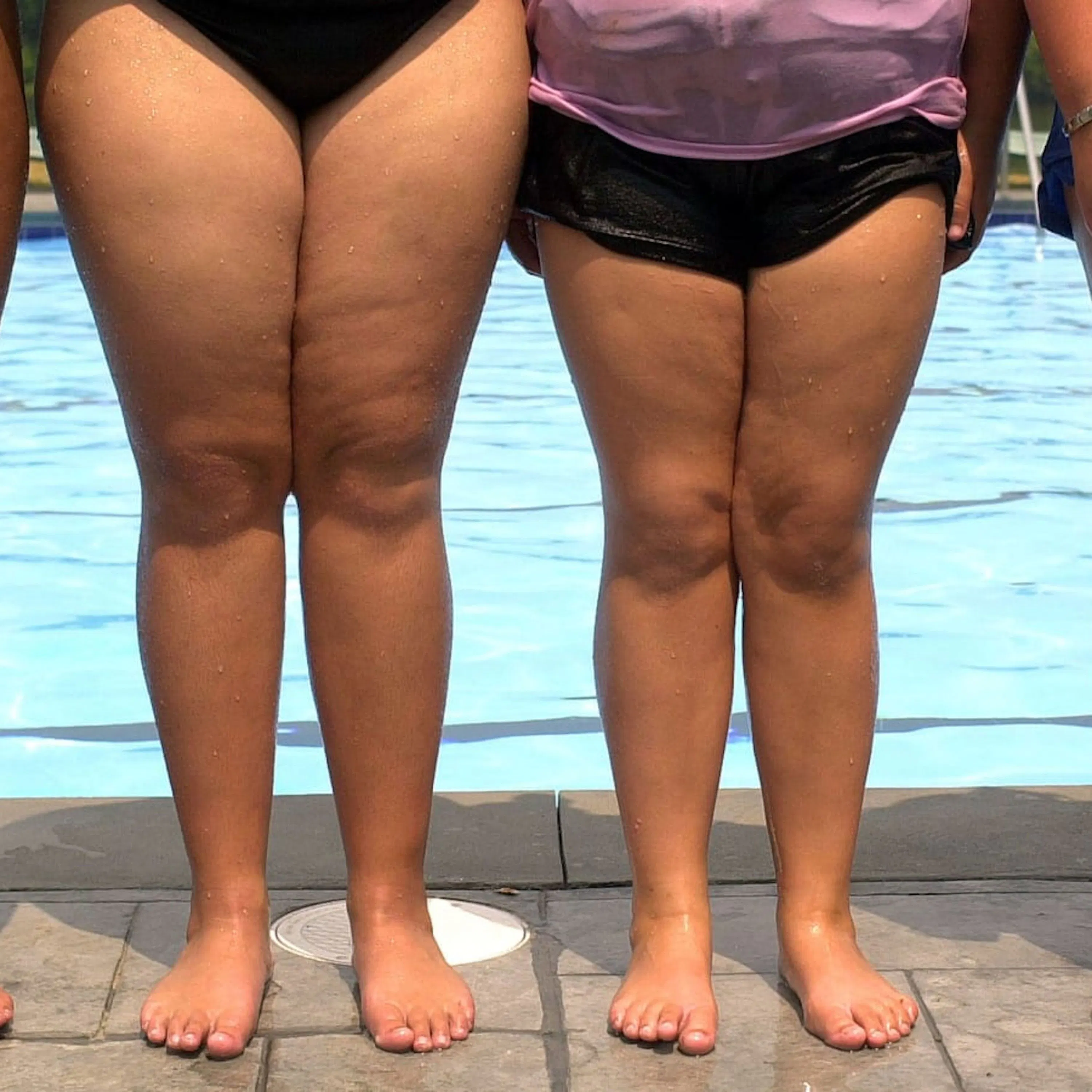 Qu'est-ce que la malnutrition ?