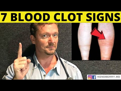 7 Warning Signs of a BLOOD CLOT (Symptoms) 2026
