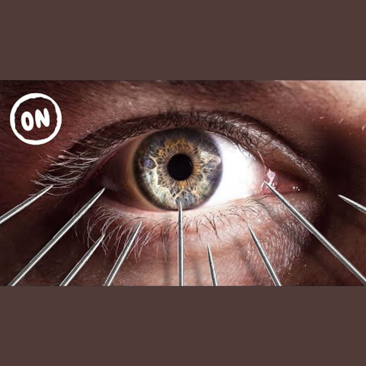 Benefits of Trying Acupuncture episode artwork