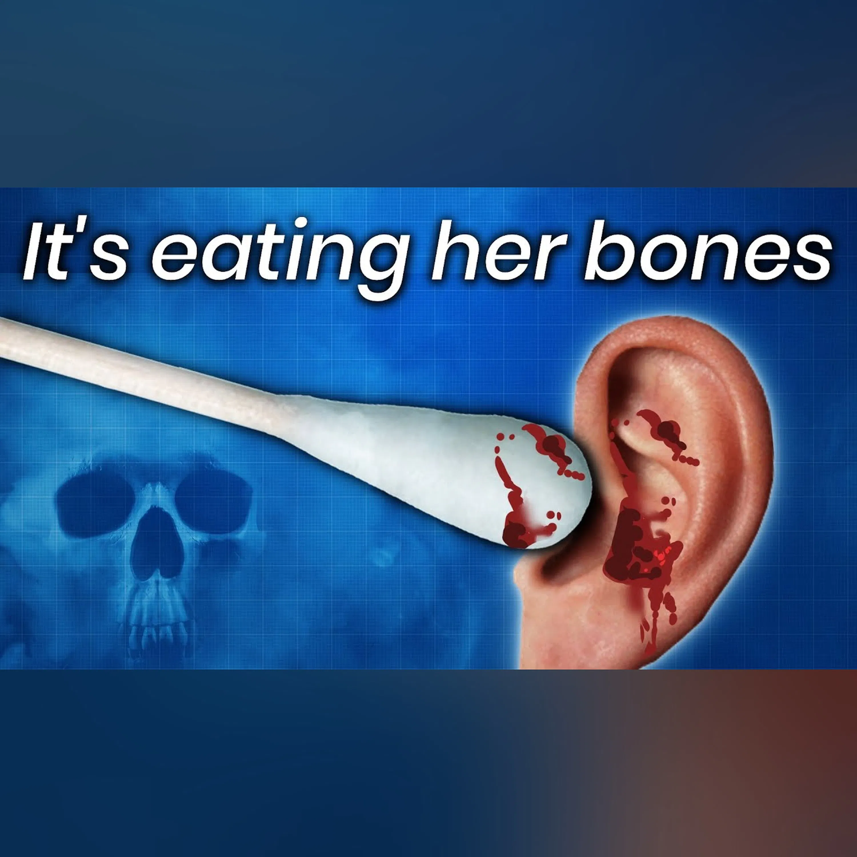 A Woman Cleaned Her Ears w/ Cotton Swabs, This Is What Happened to Her Bones