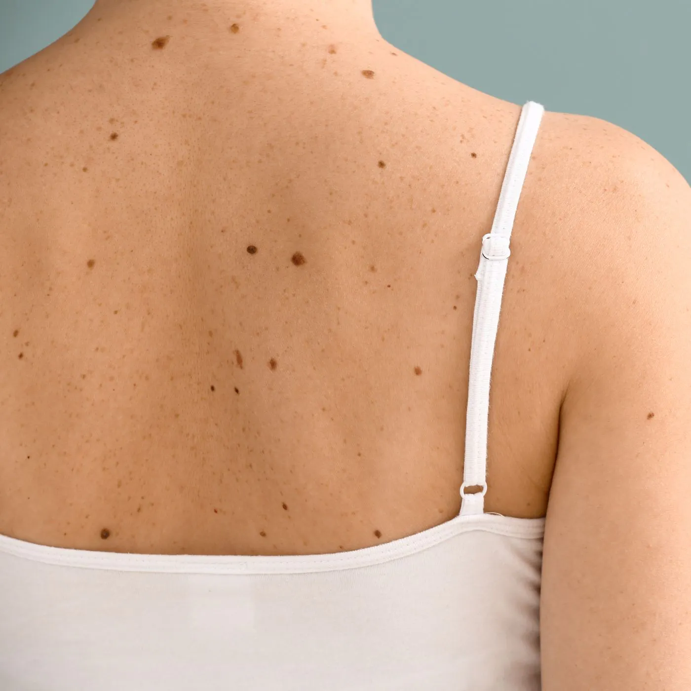 Pourquoi a-t-on des grains de beauté ?