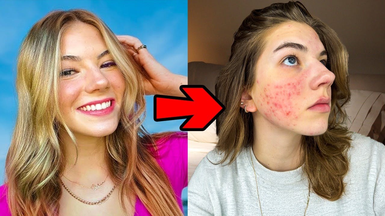 Acne Is Ruining My Life! Acne Is Ruining My Life!