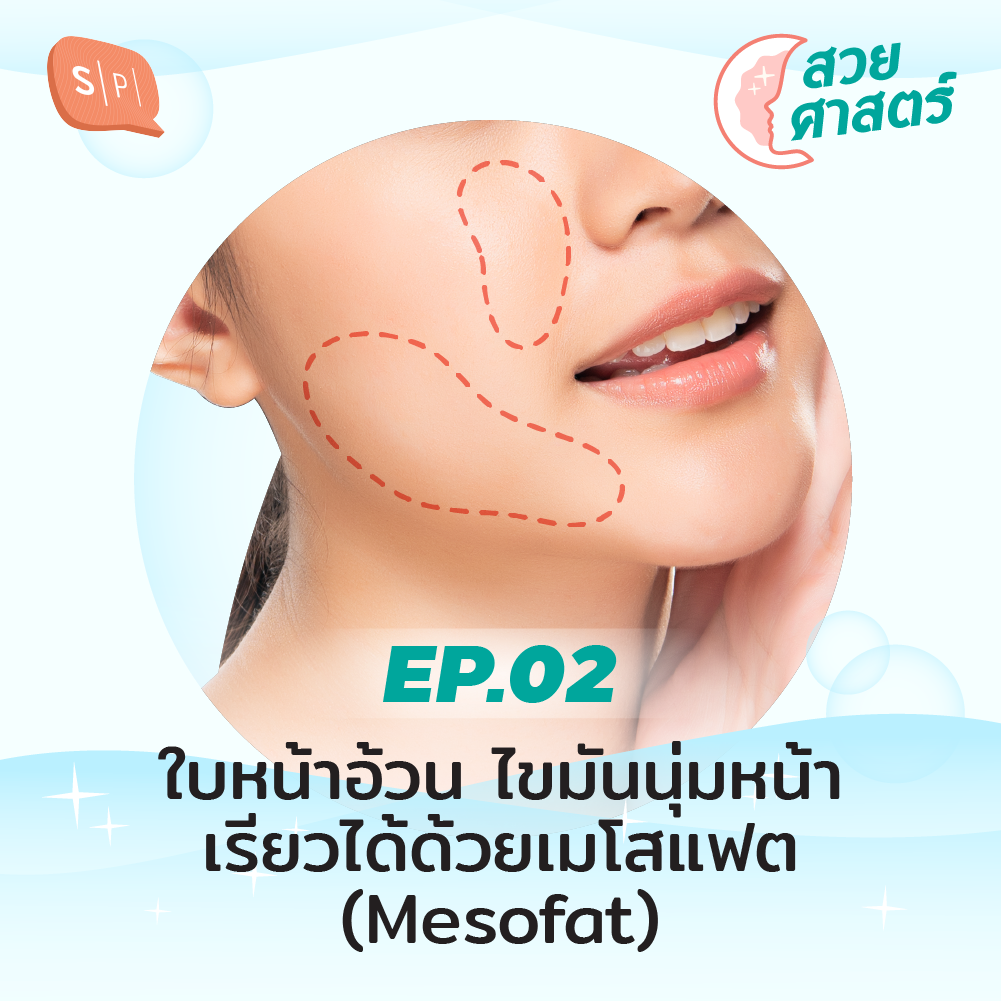 SUAY02 ใบหน้าอ้วน ไขมันนุ่มหน้า เรียวได้ด้วยเมโสแฟต (Mesofat)