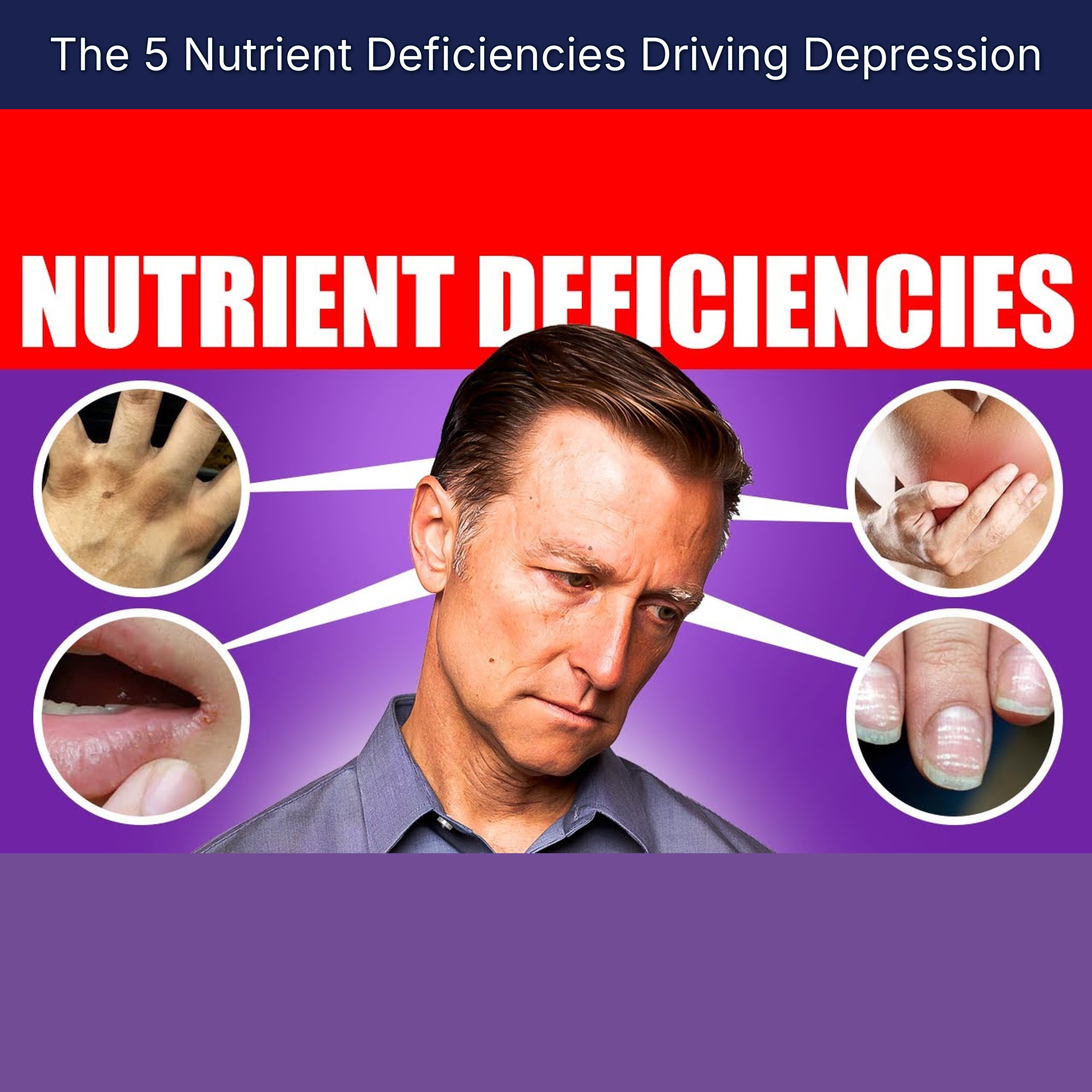 The 5 Nutrient Deficiencies Driving Depression