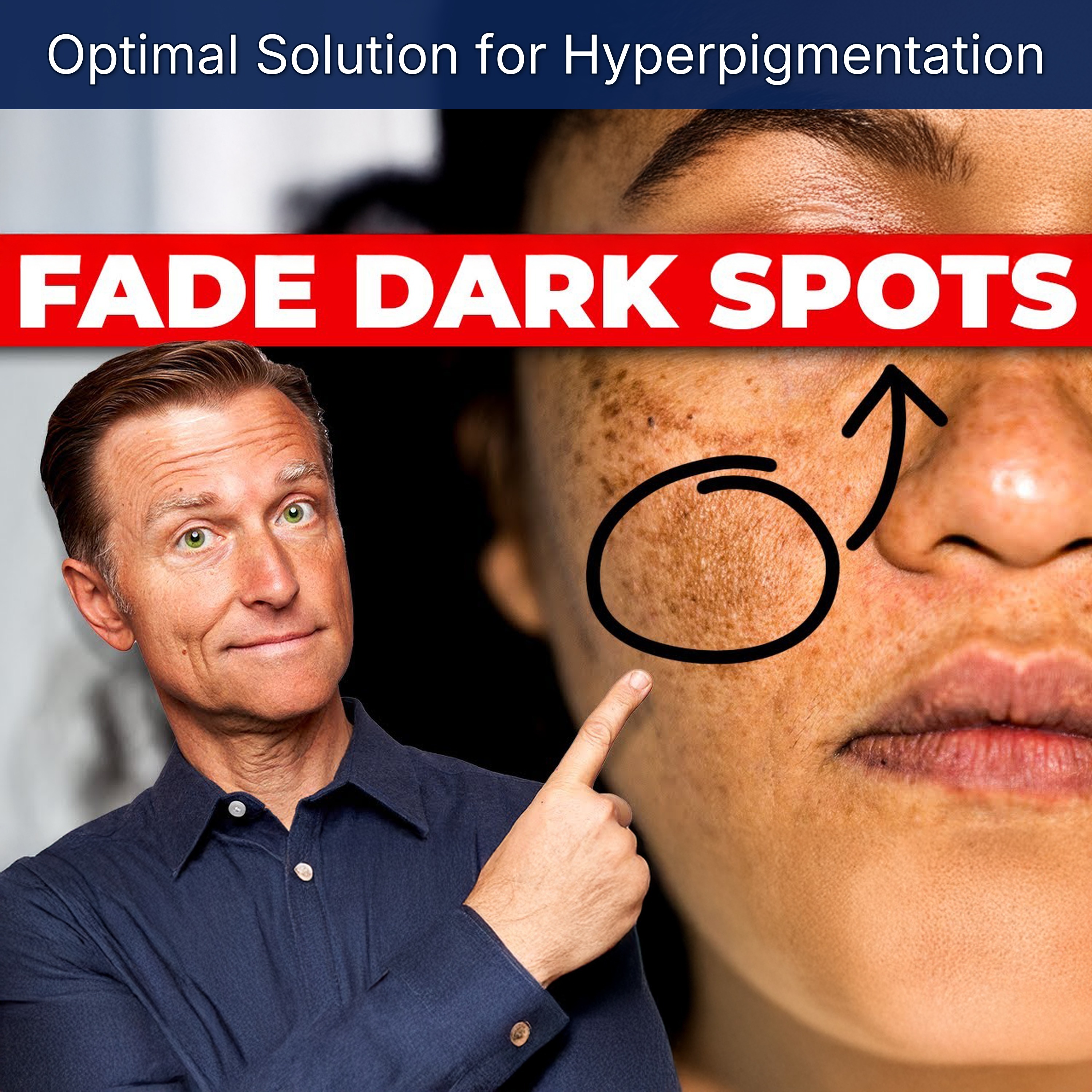 Optimal Solution for Hyperpigmentation