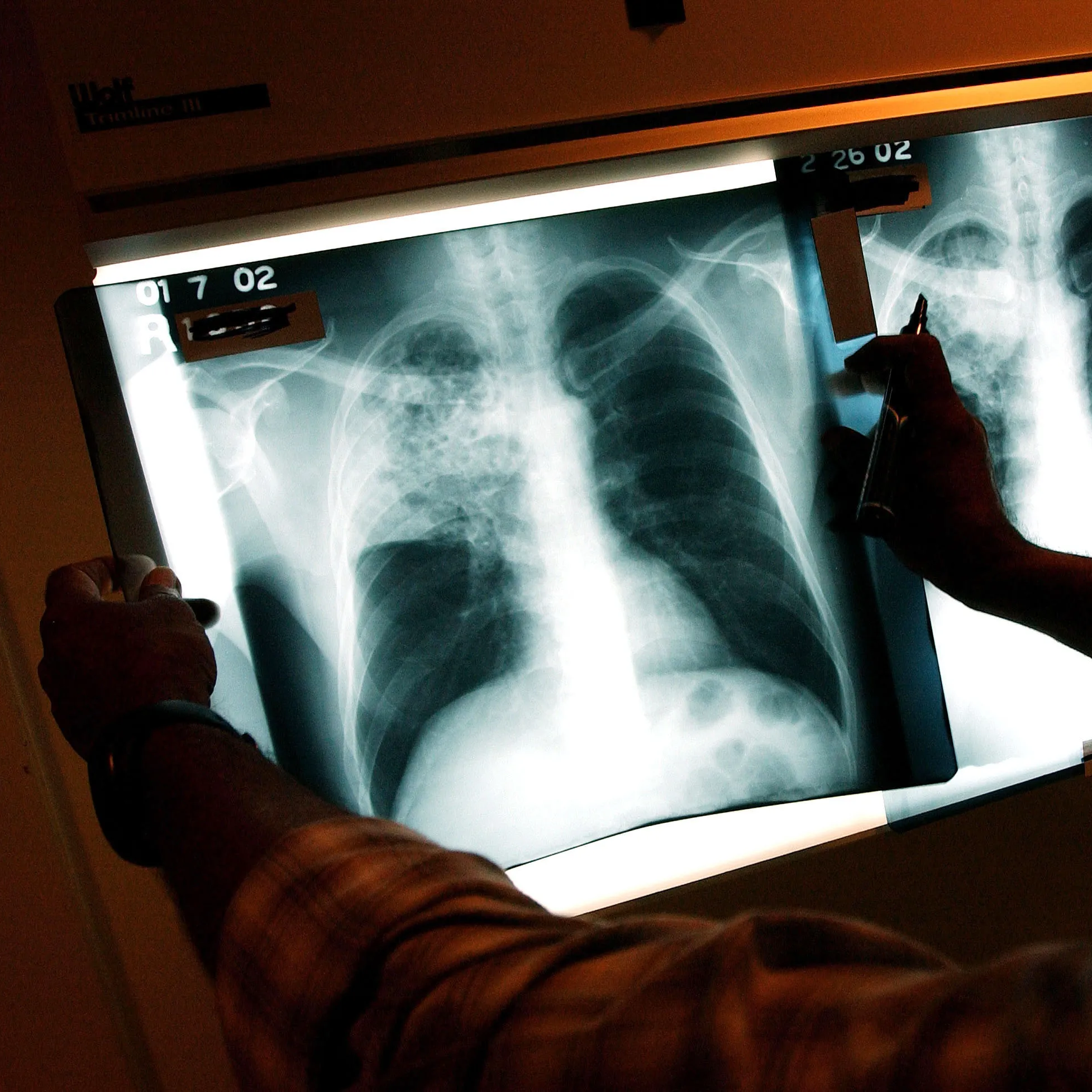 Turning the Page on Tuberculosis
