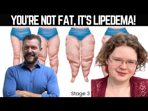 It's NOT Obesity, it's Lipedema [with Siobhan Huggins]