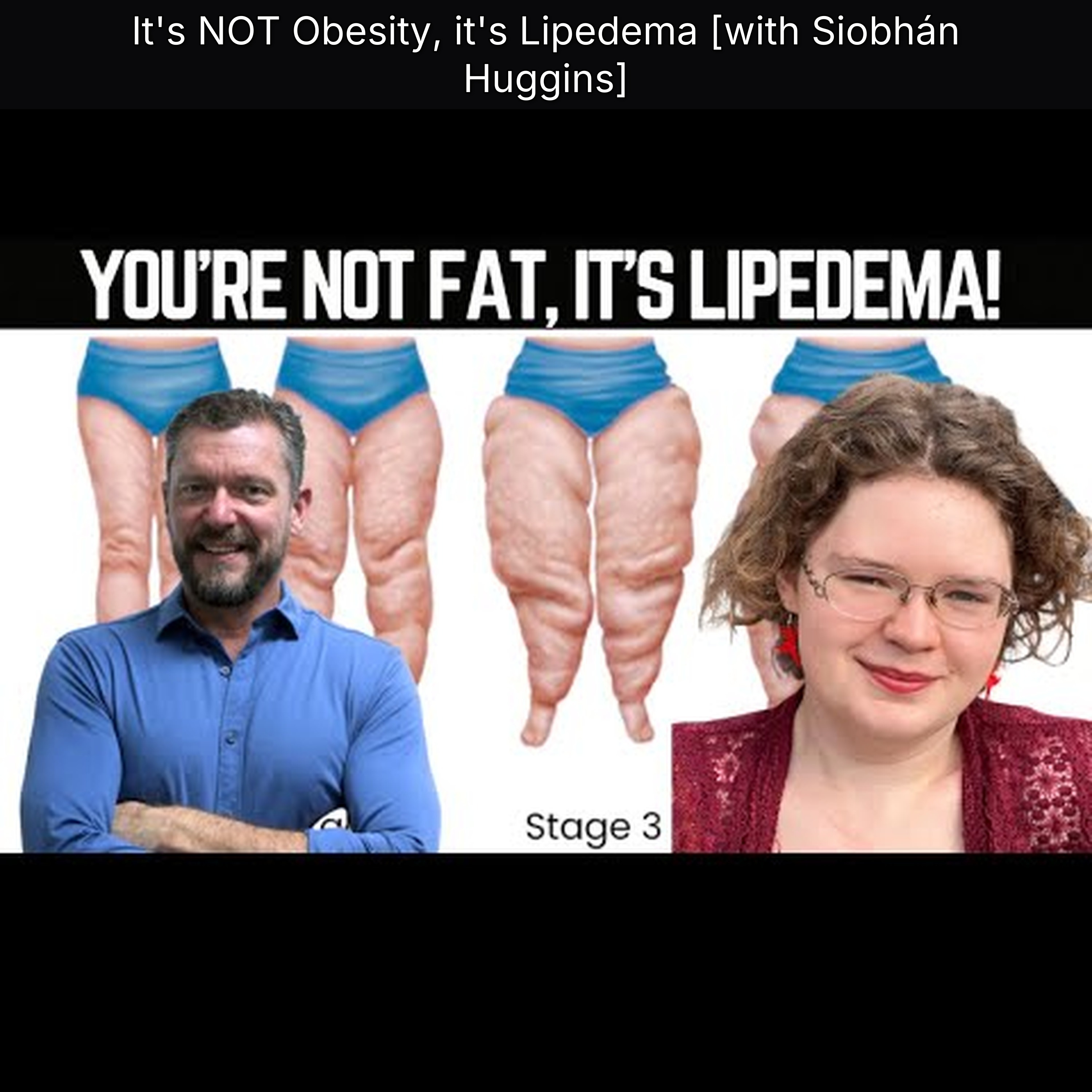 It's NOT Obesity, it's Lipedema [with Siobhán Huggins]