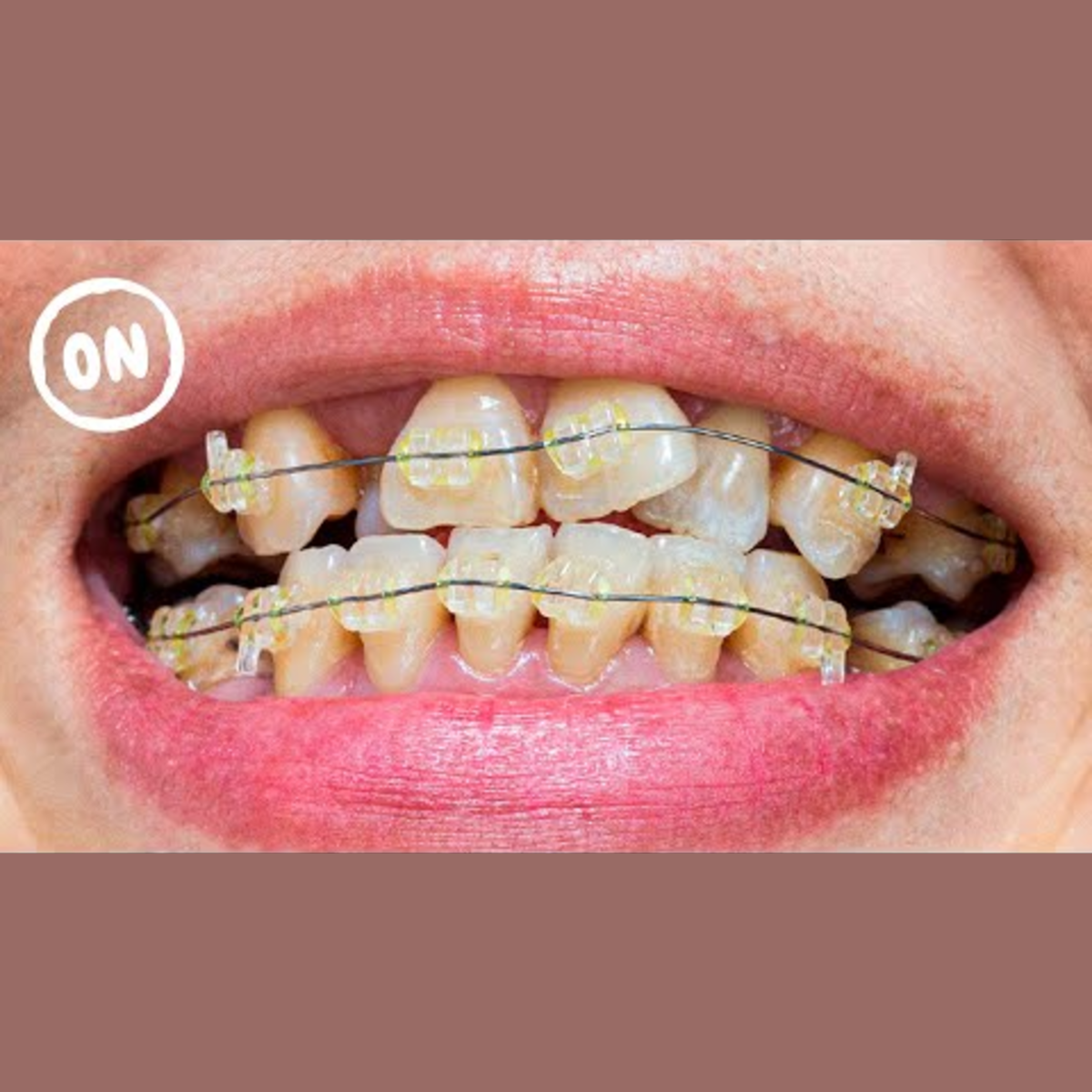 The Impact of Wearing Braces for a Decade on Dental Health episode artwork