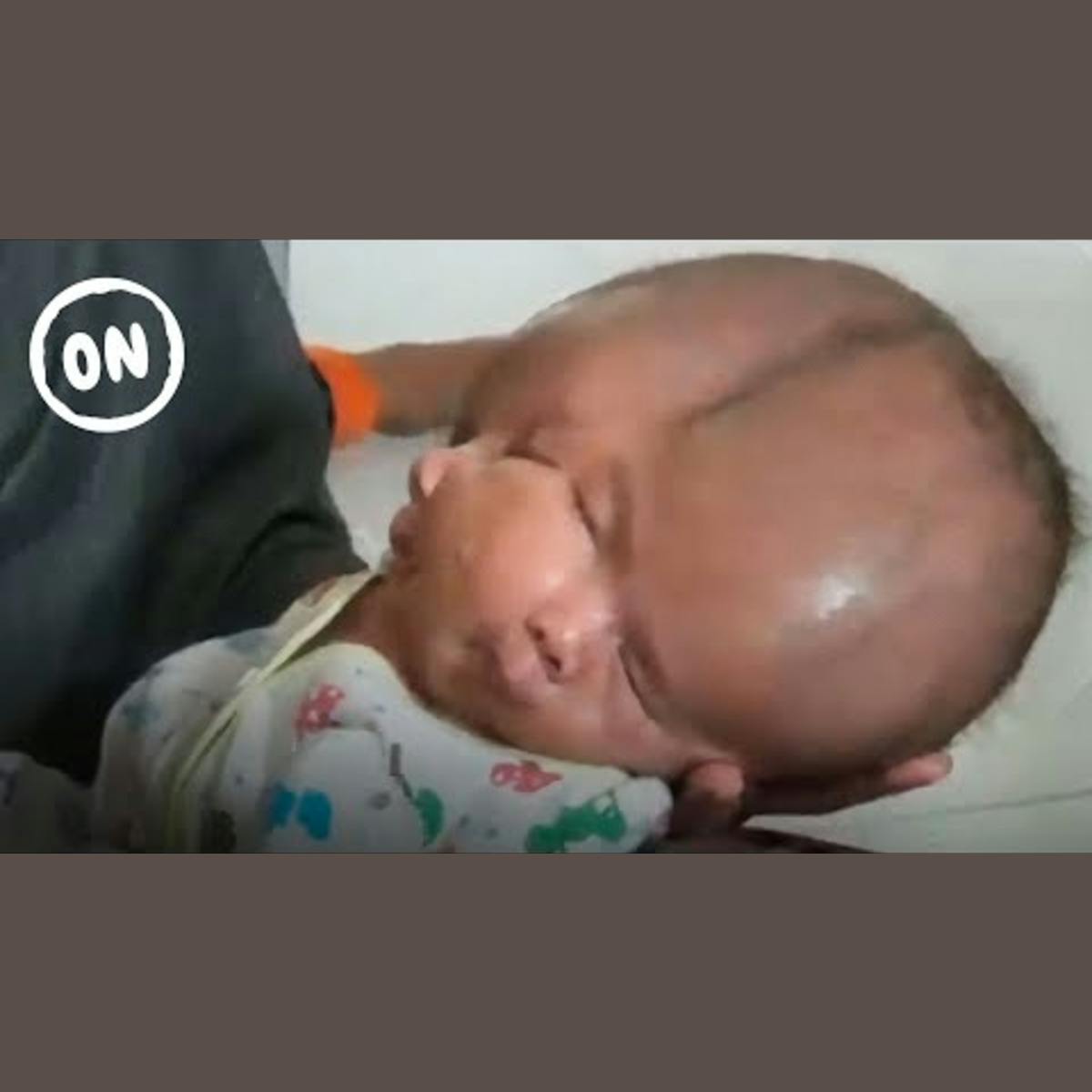 Remarkable Lives of Conjoined Twins: 5 Compelling Stories Remarkable Lives of Conjoined Twins: 5 Compelling Stories