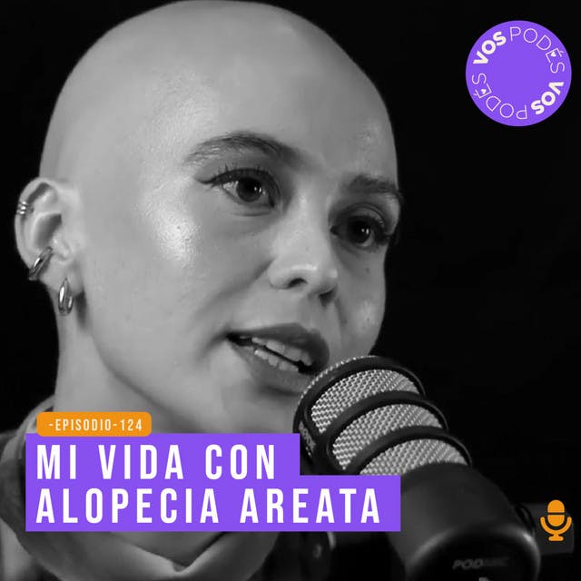 Mi vida con alopecia areata - invitada Mafe Benitez