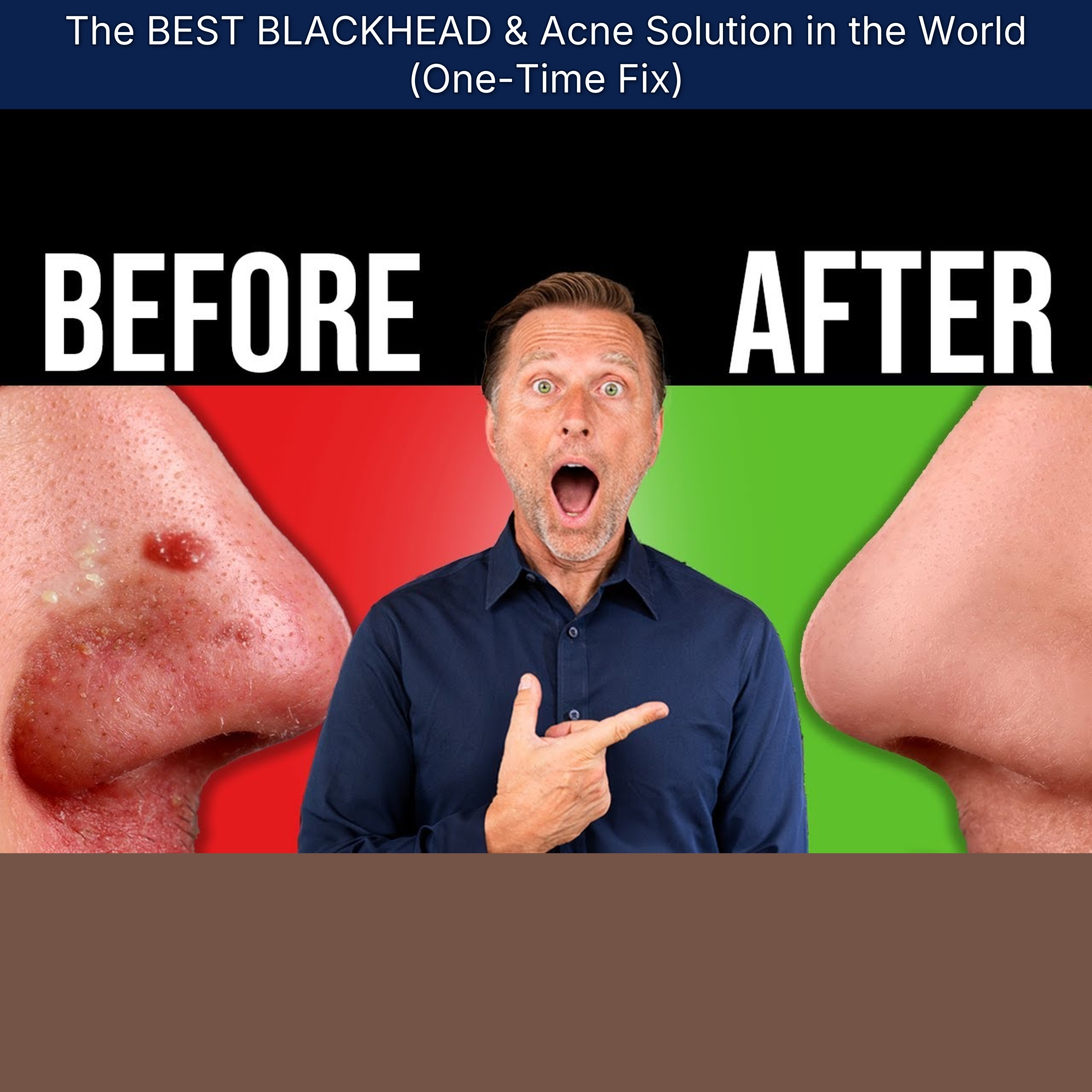 The BEST BLACKHEAD & Acne Solution in the World (One-Time Fix)