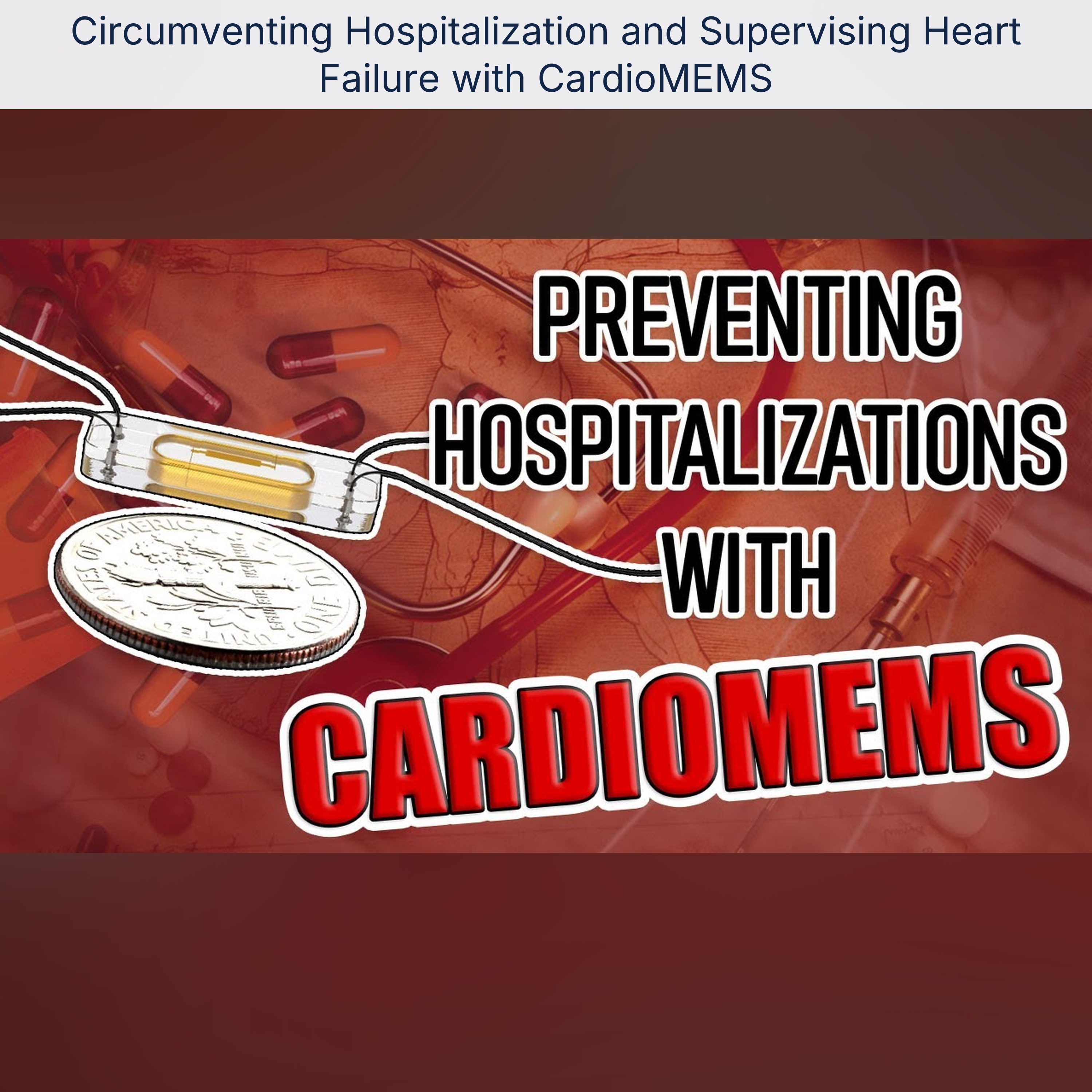 Circumventing Hospitalization and Supervising Heart Failure with CardioMEMS