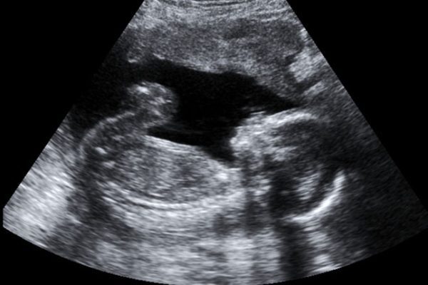 Seeking Support: Miscarriage and Infant Loss