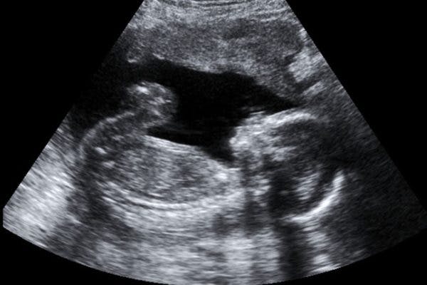 Seeking Support: Miscarriage and Infant Loss Seeking Support: Miscarriage and Infant Loss