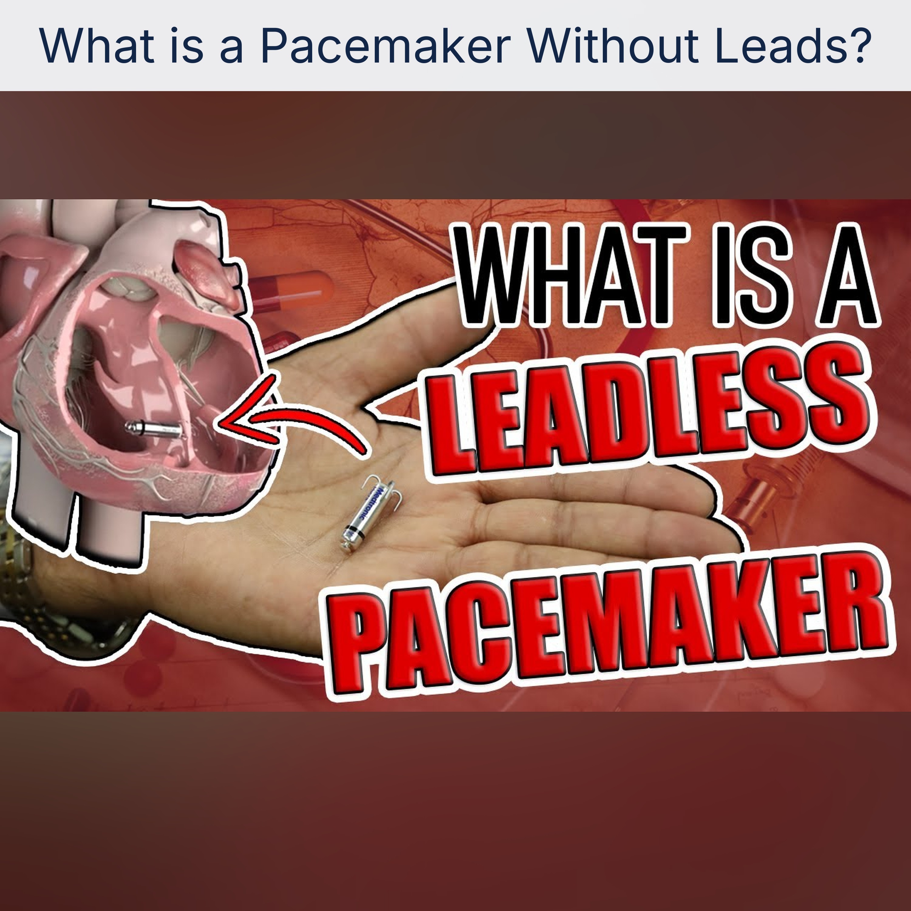 What is a Pacemaker Without Leads?