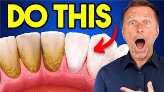 The #1 BEST Remedy for Dental Plaque (TARTAR)