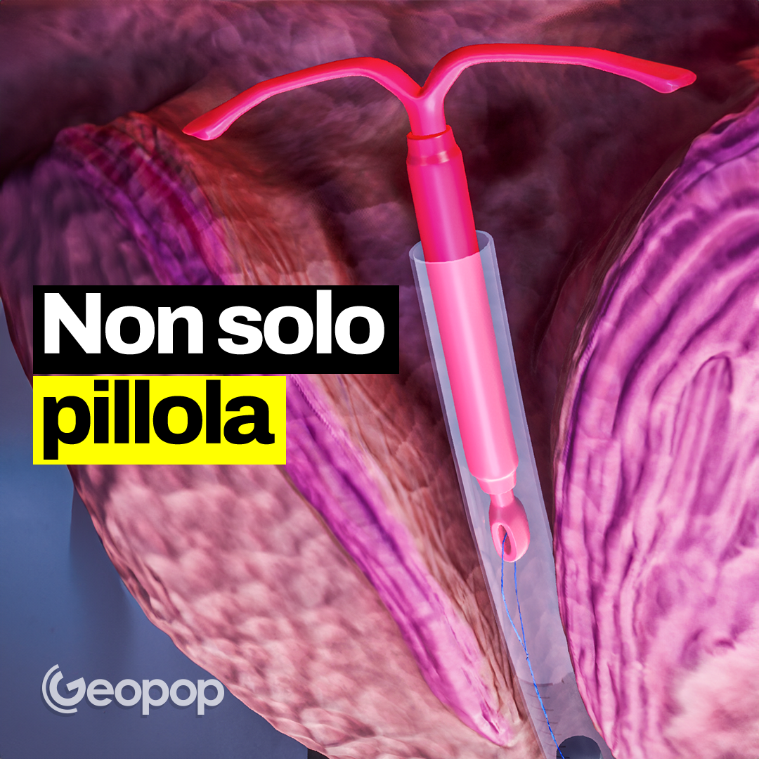 331 - Come funzionano i metodi contraccettivi femminili e maschili e quali sono i più efficaci