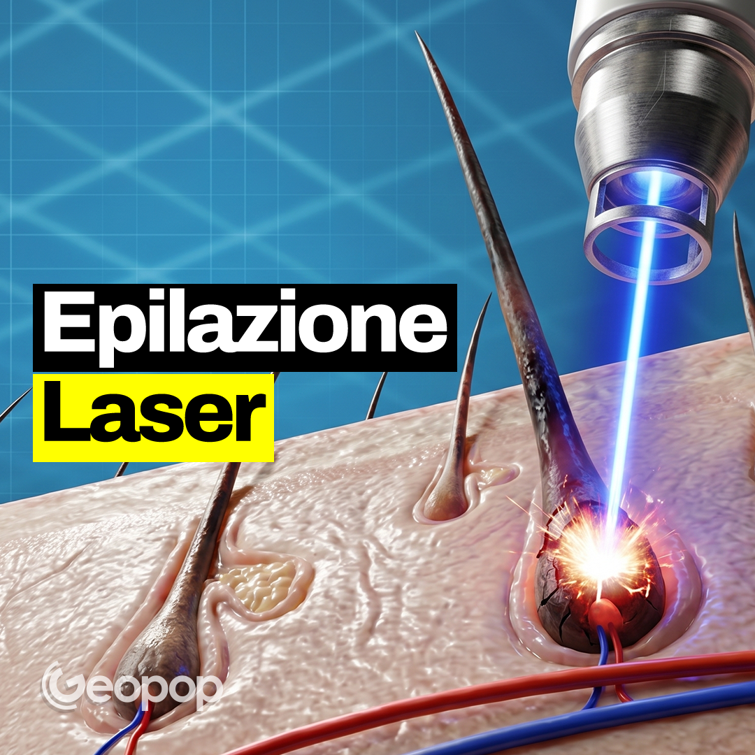380 - L'epilazione laser e la tecnologia che c'è dietro: come funziona sui peli e quanto è efficace