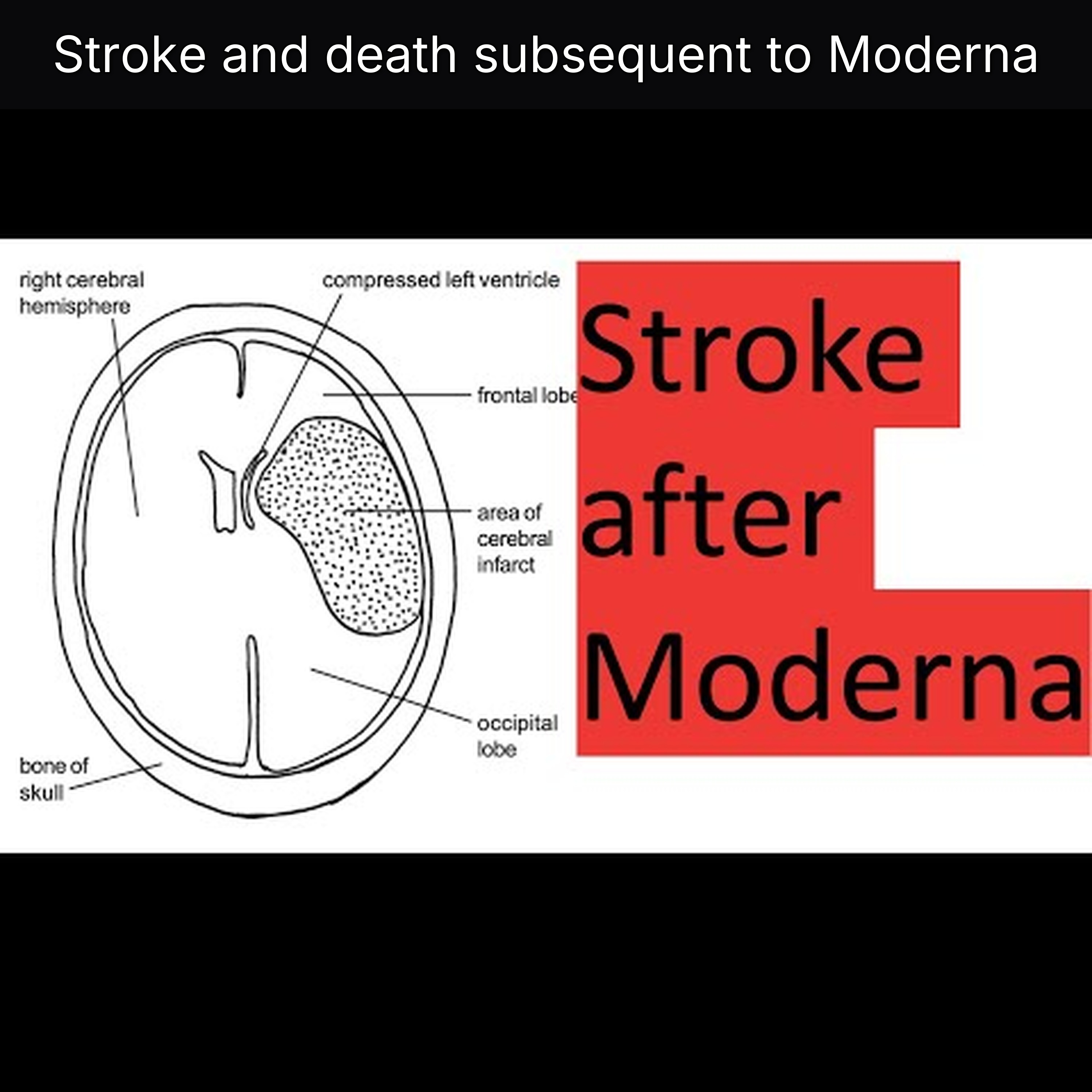 Stroke and death subsequent to Moderna