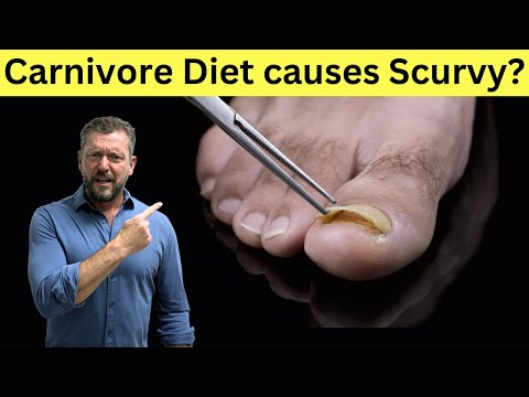 Does the Carnivore Diet cause Scurvy?? [Dietitian vs Doctor]