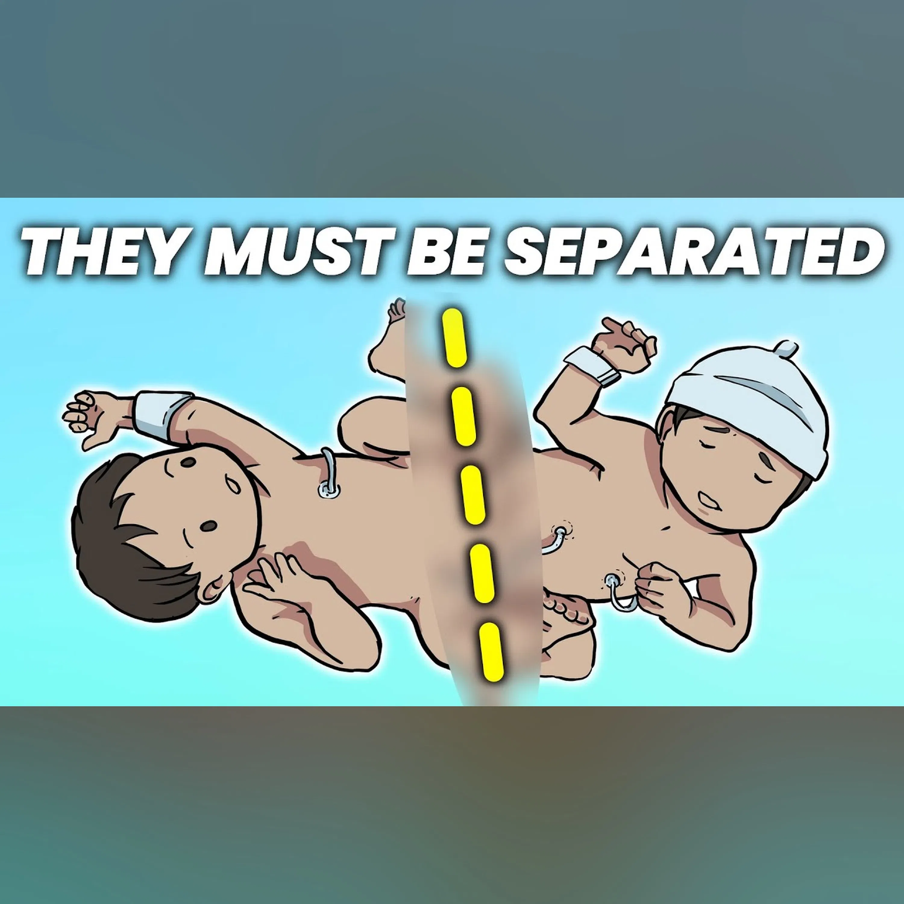 What Happens When Conjoined Twins Must Be Separated