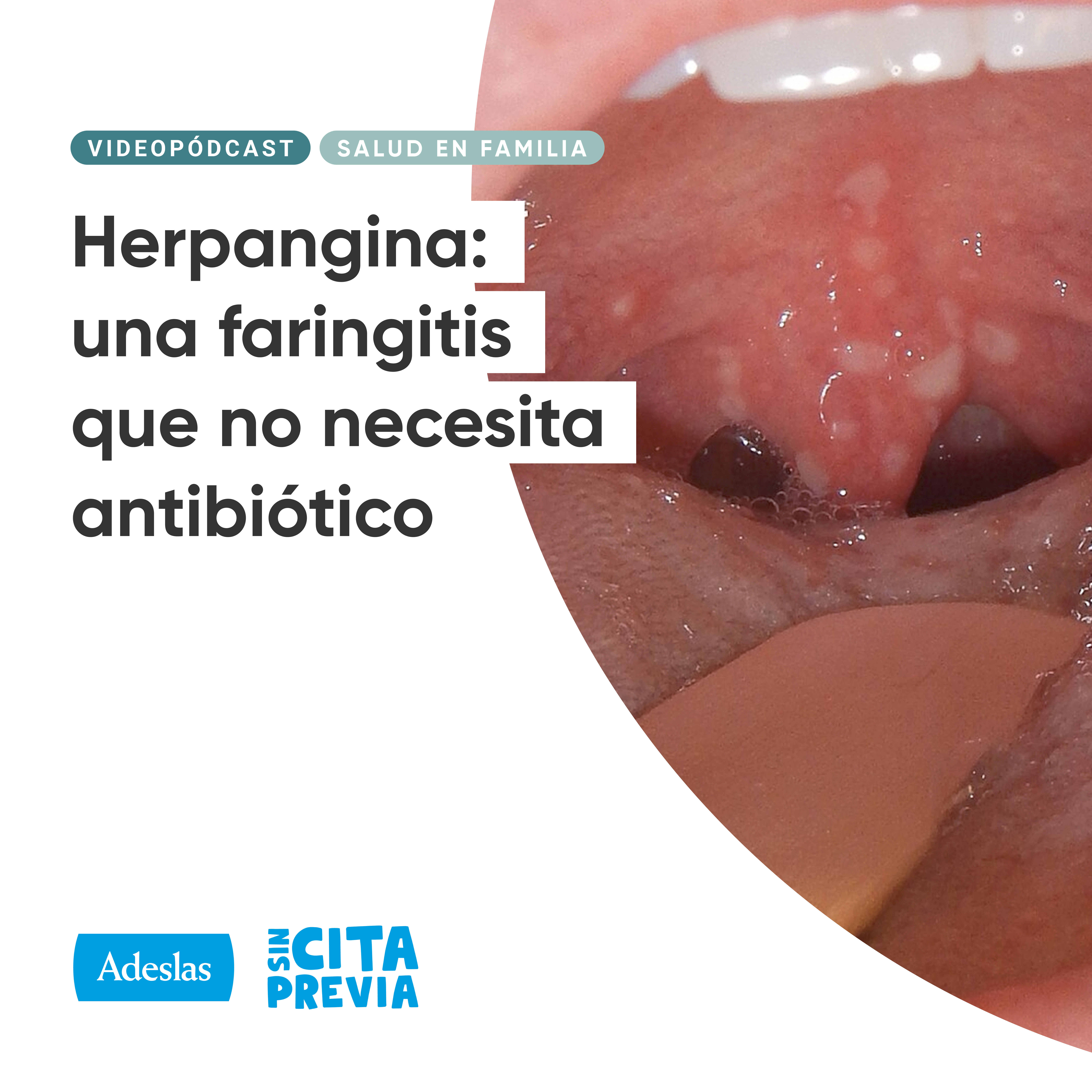 Herpangina: una faringitis que no necesita antibiótico
