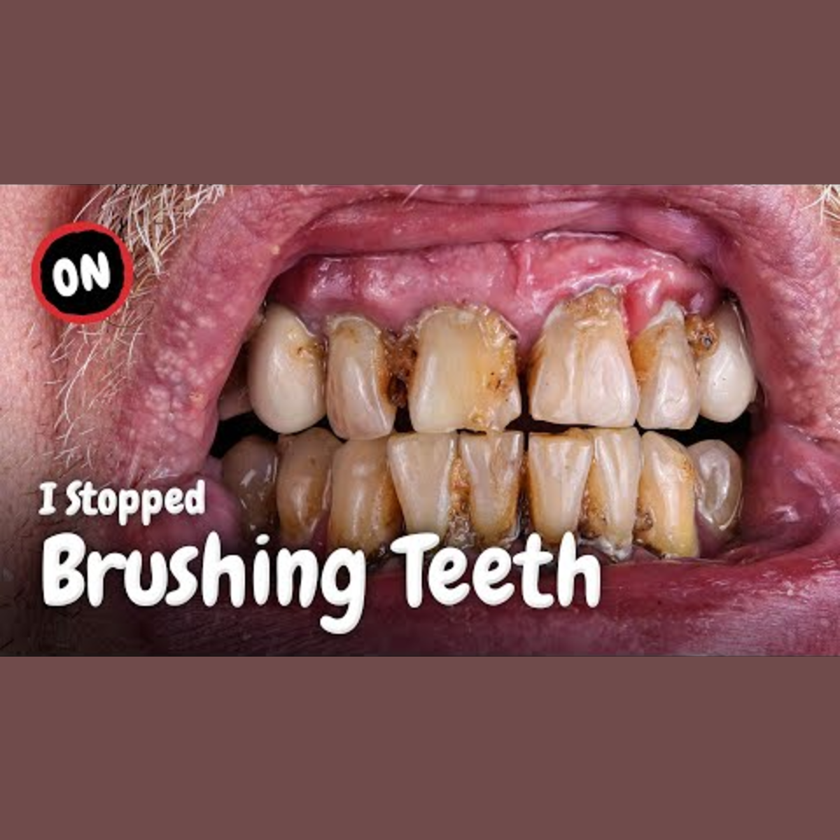 Consequences of Skipping Dental Hygiene episode artwork
