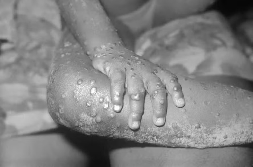 Casos de Mpox no estado do Rio de Janeiro crescem 77% em comparação ao ano passado episode artwork