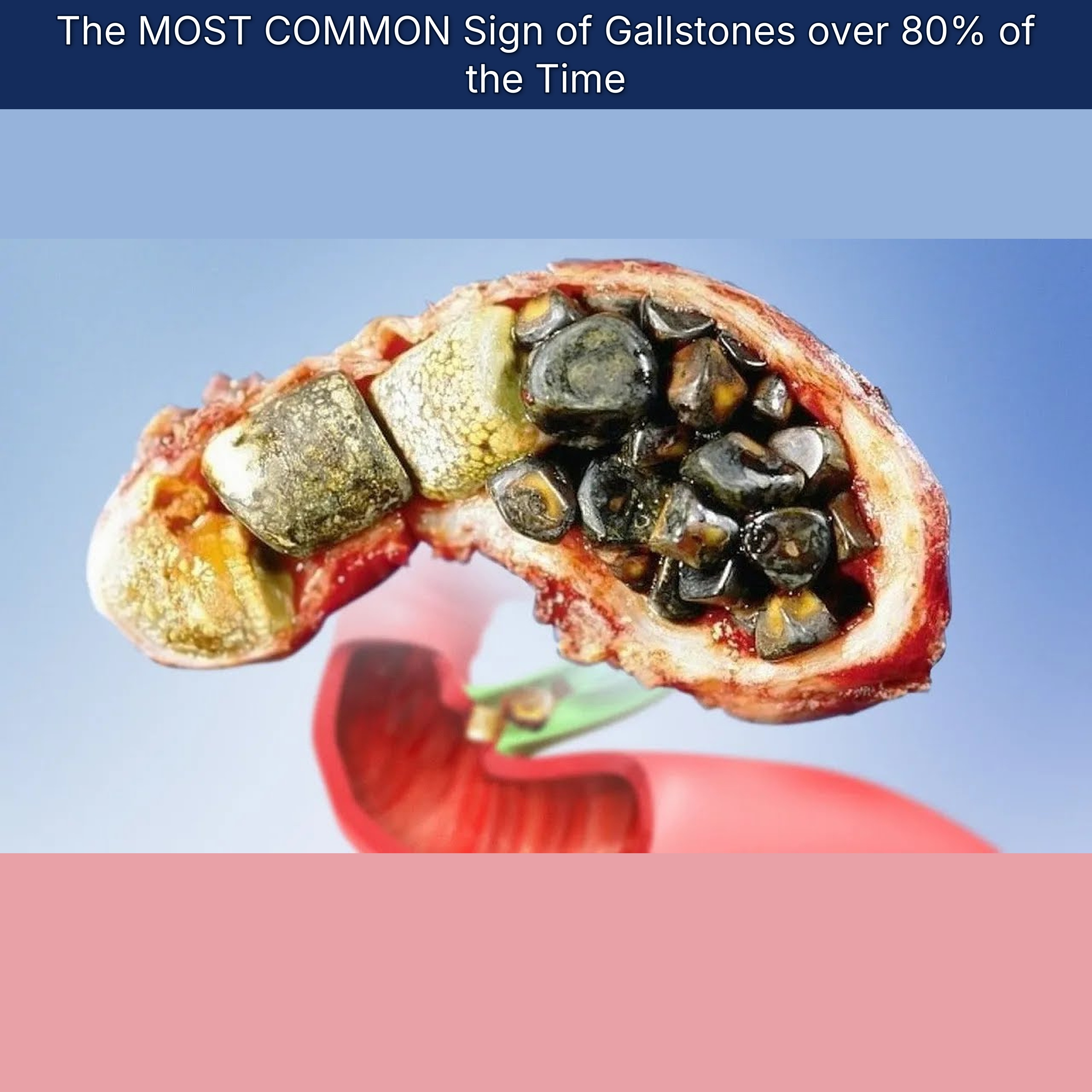 The MOST COMMON Sign of Gallstones over 80% of the Time