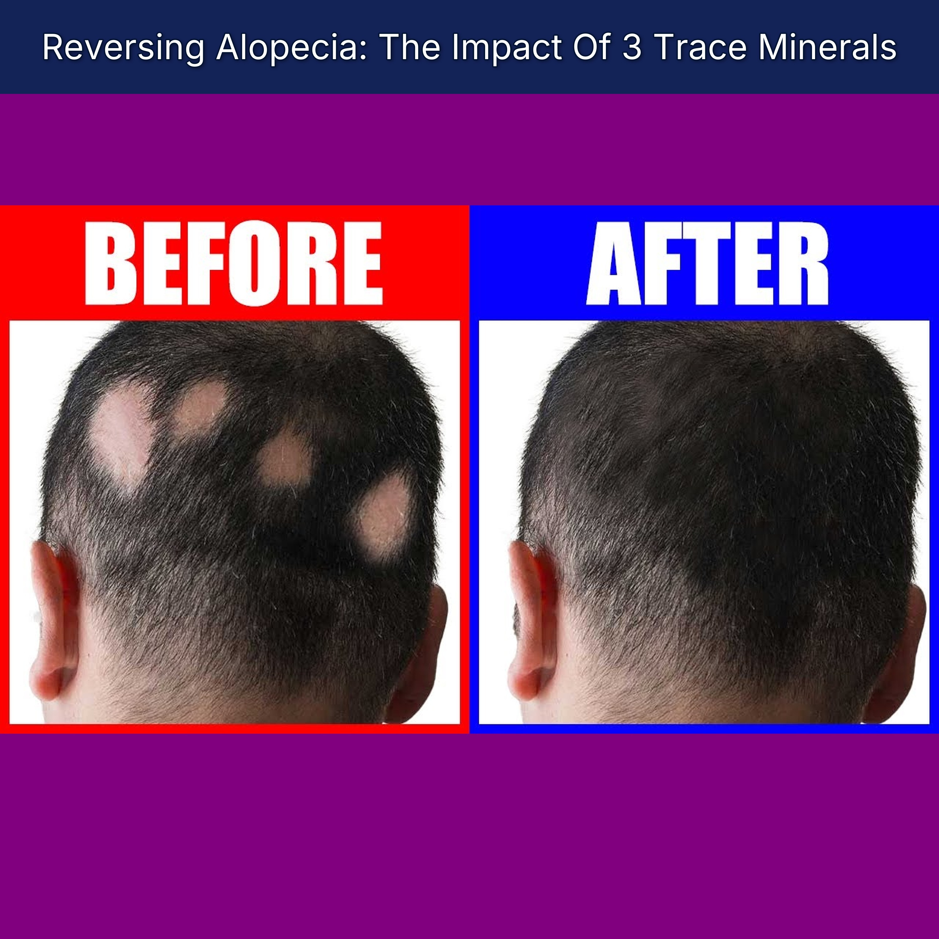 Reversing Alopecia: The Impact Of 3 Trace Minerals