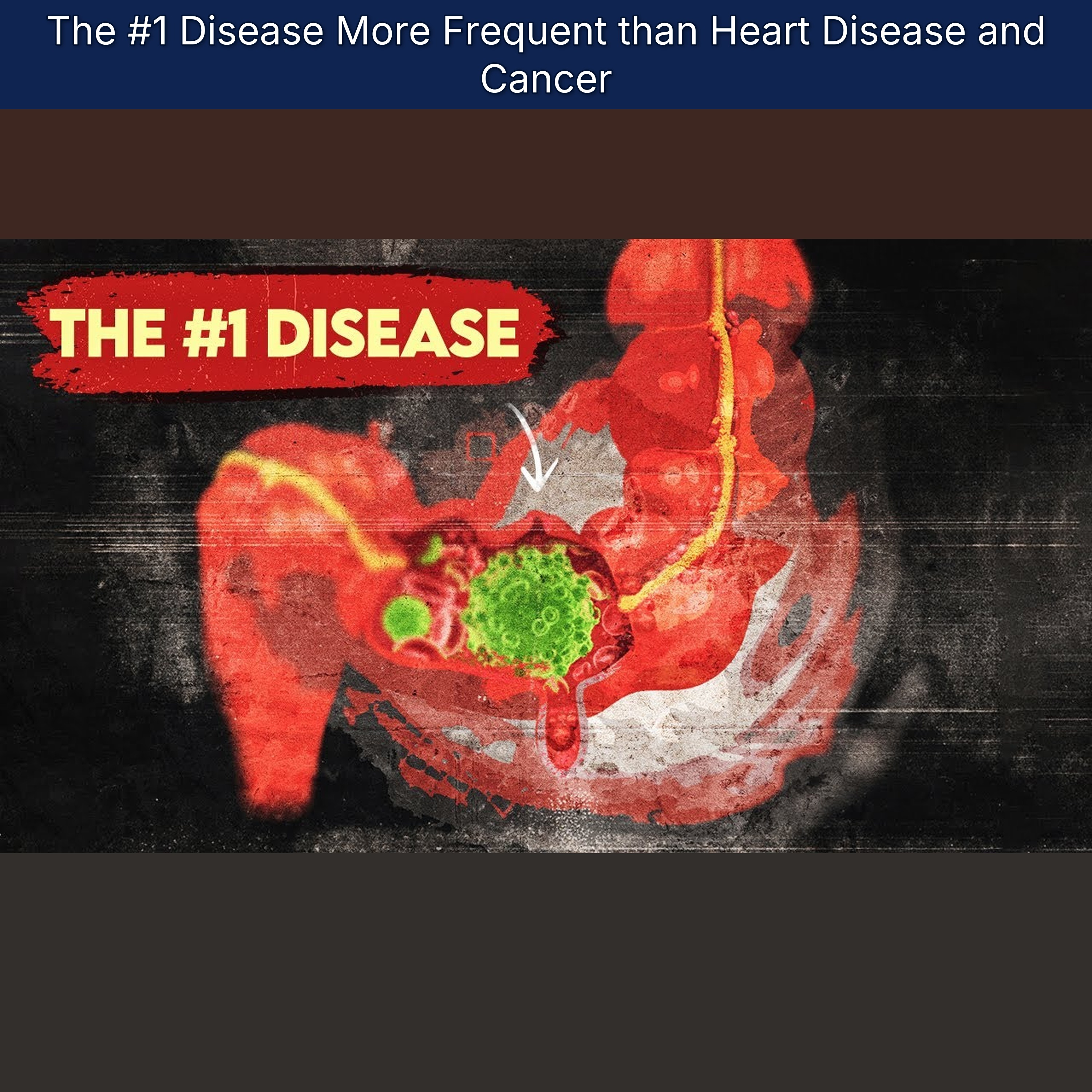 The #1 Disease More Frequent than Heart Disease and Cancer