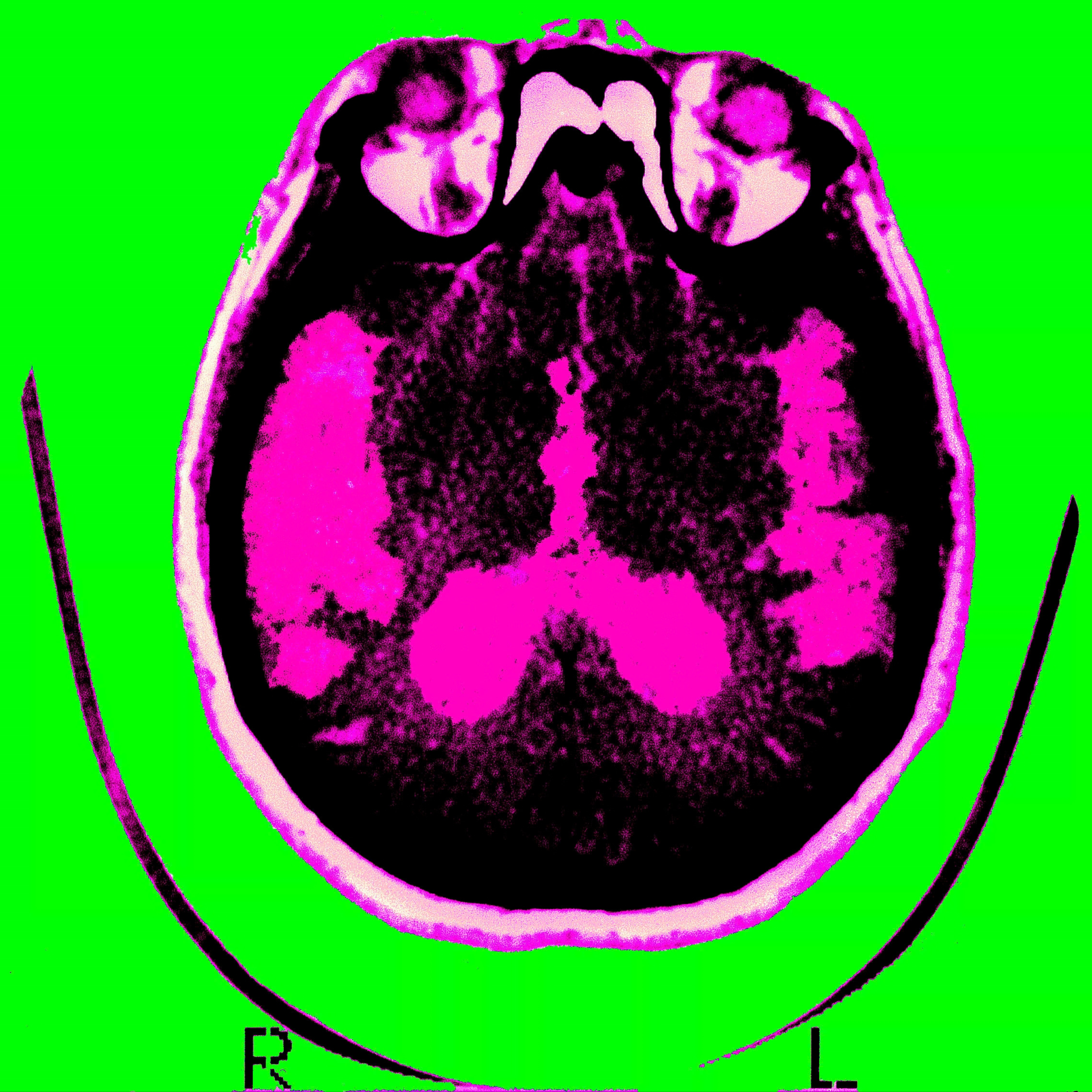 Good news about Alzheimer’s