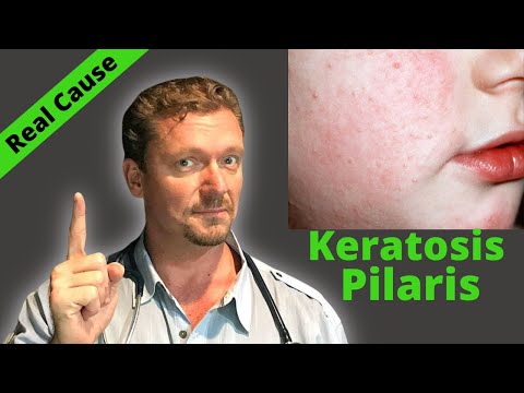 KERATOSIS PILARIS Fix? (Sign of Serious Condition?) Chicken Skin Cure