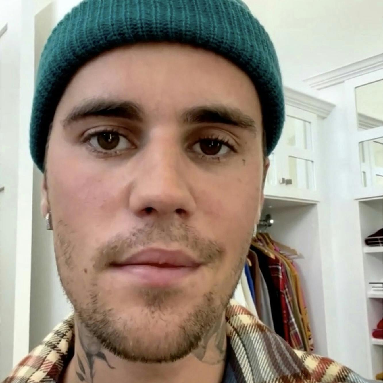 Justin Bieber shares update after revealing his face is partially paralyzed Image