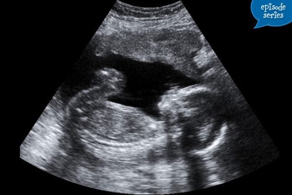 Miscarriage and Stillbirth: Dealing with Loss Miscarriage and Stillbirth: Dealing with Loss