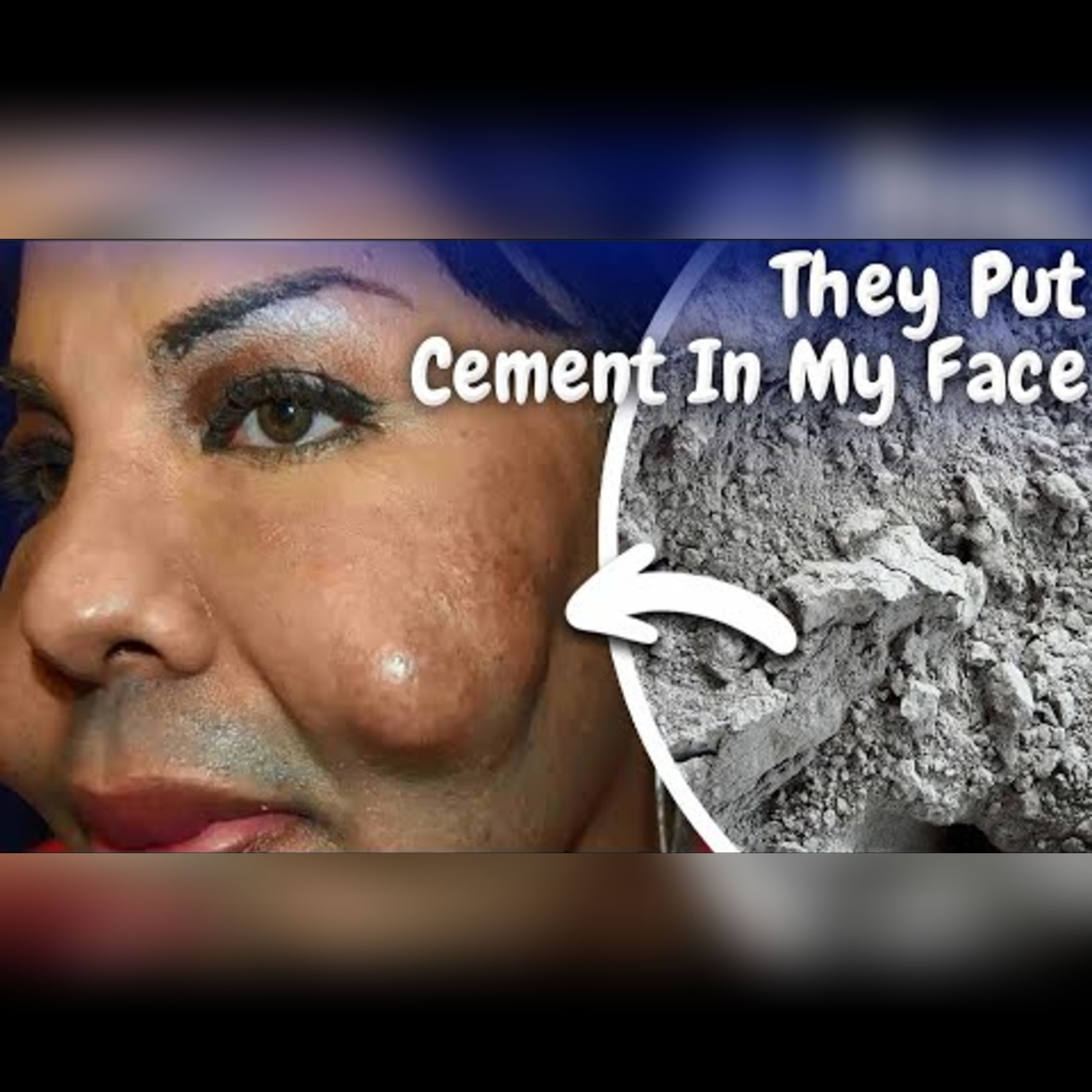 Plastic Surgeon Used Cement in Surgeries with Fatal Consequences episode artwork