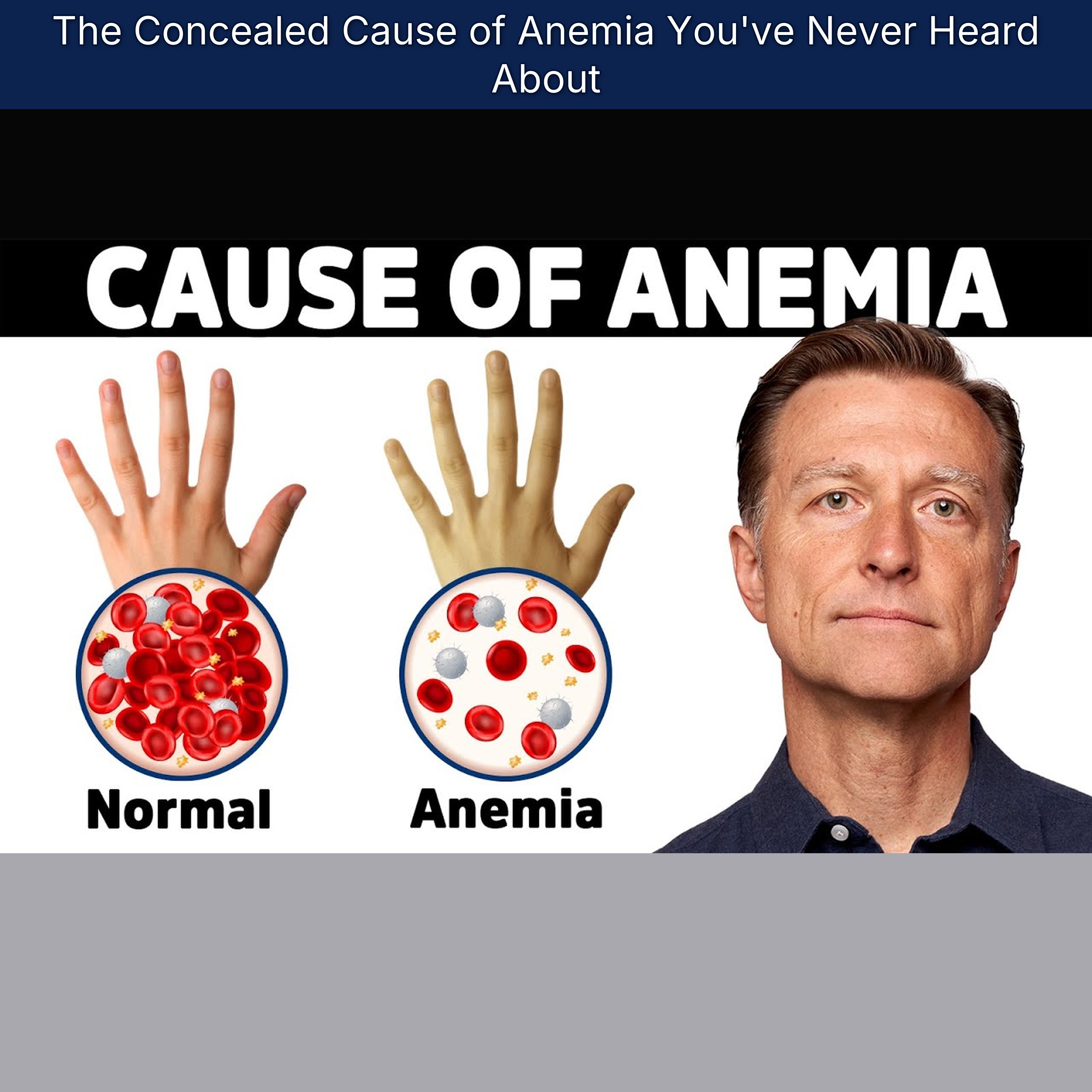 The Concealed Cause of Anemia You've Never Heard About