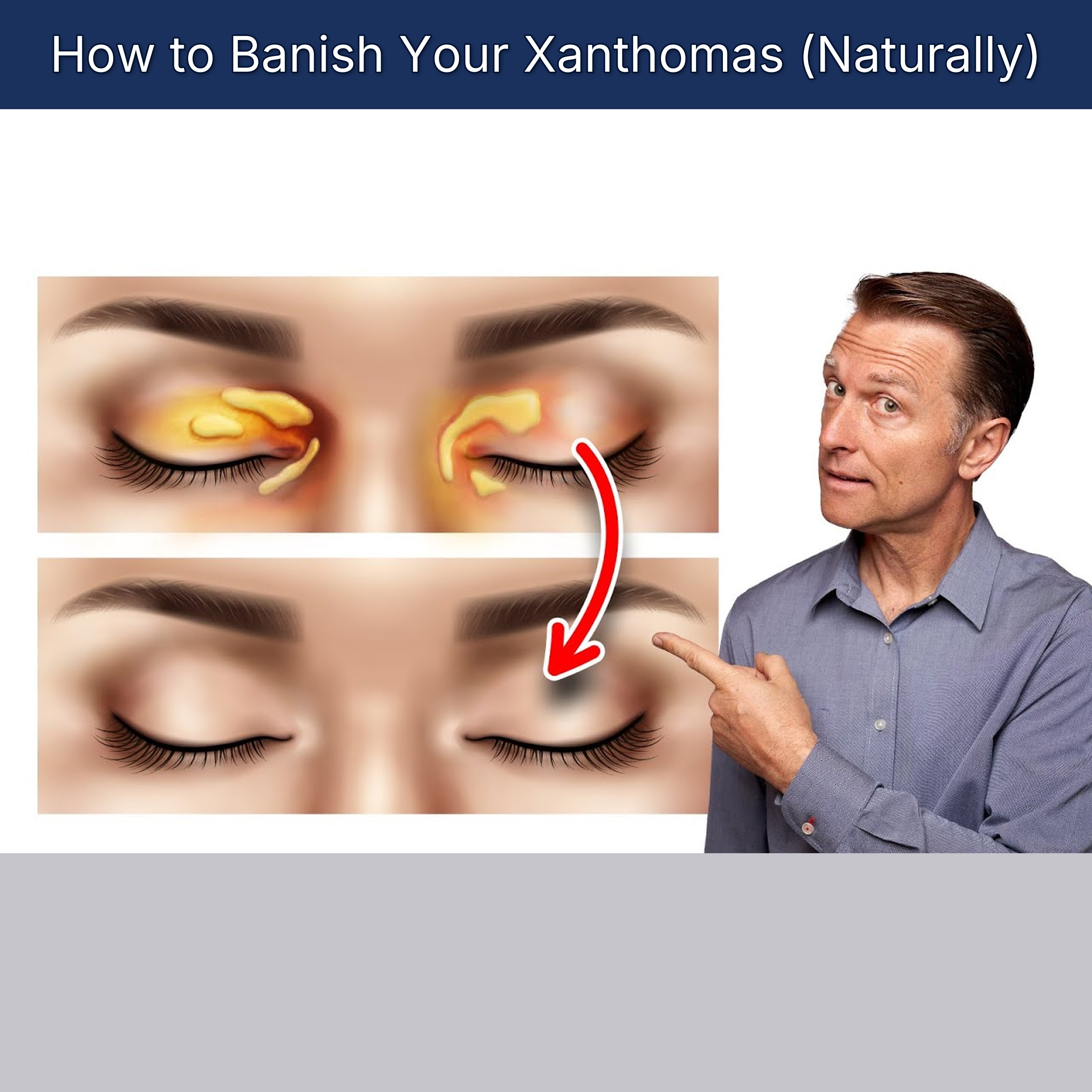 How to Banish Your Xanthomas (Naturally)