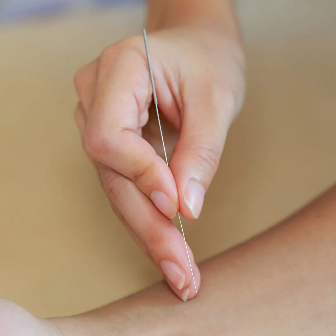 Acupuncture : quelles sont les 5 raisons de consulter ?