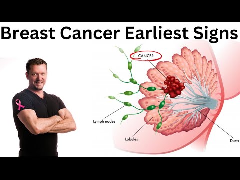 Earliest Signs of Breast Cancer [Doctor Explains] 2026