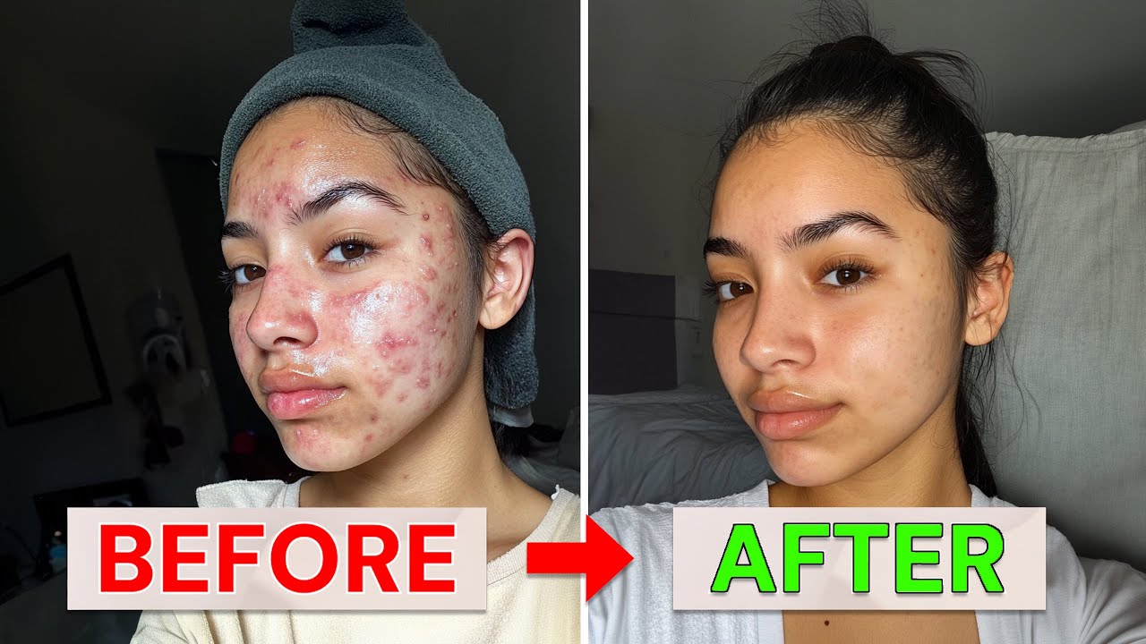 The Fastest Way to Get Rid of Acne episode artwork