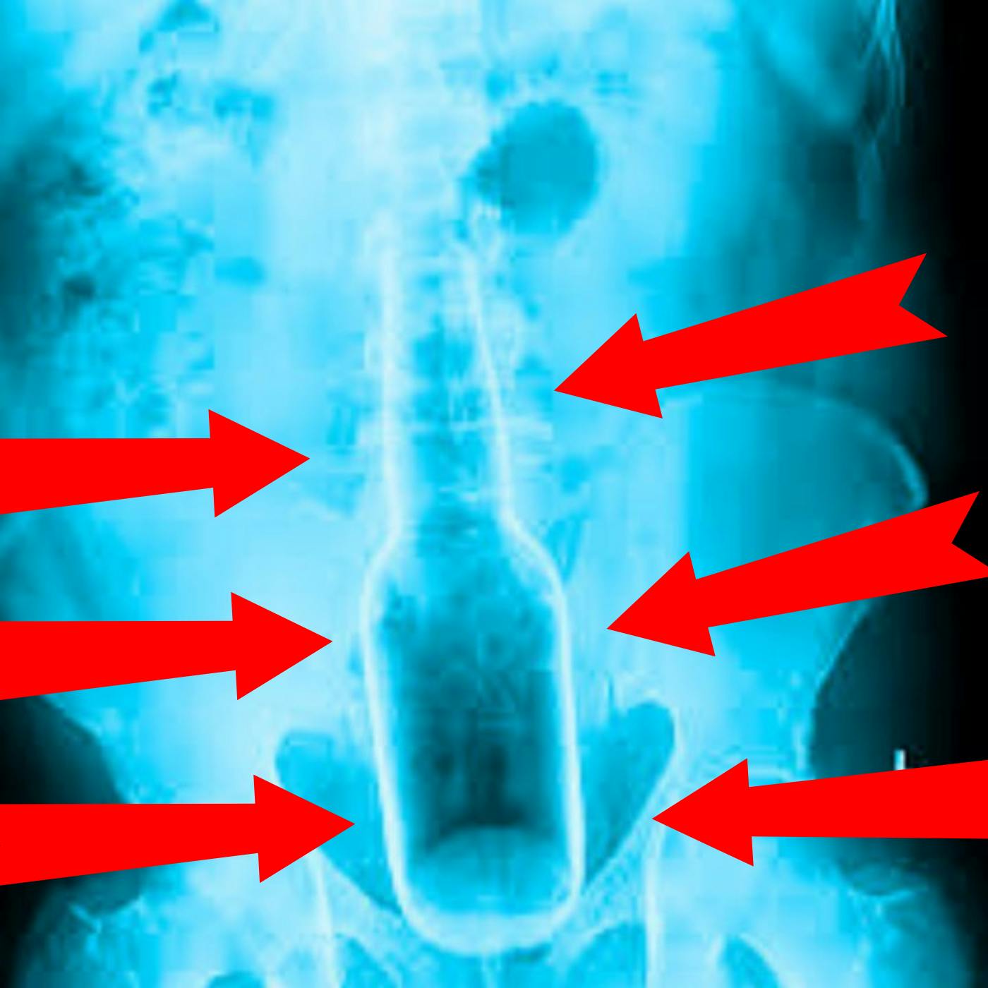 What was the most Embarrassing thing you've had to go to the ER for? What was the most Embarrassing thing you've had to go to the ER for?