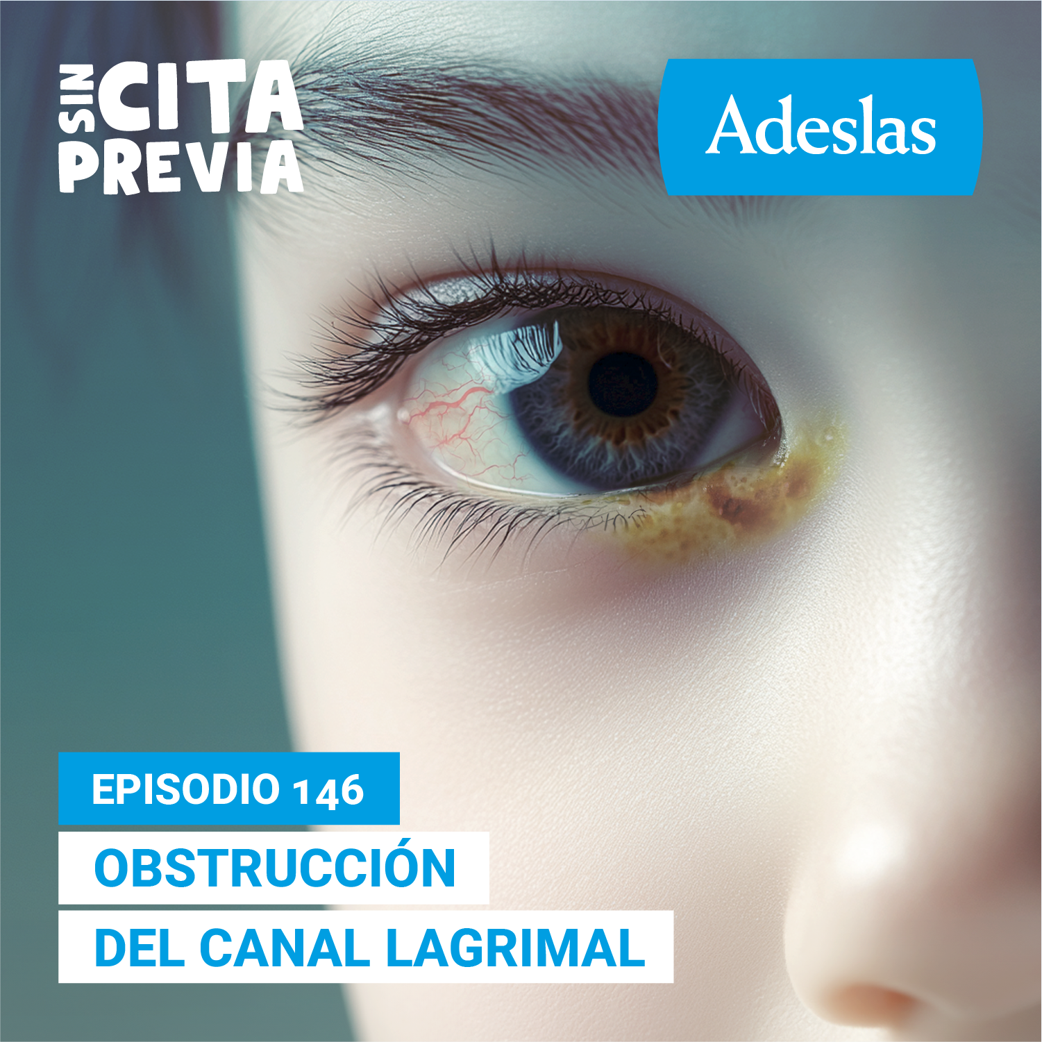Obstrucción del canal lagrimal