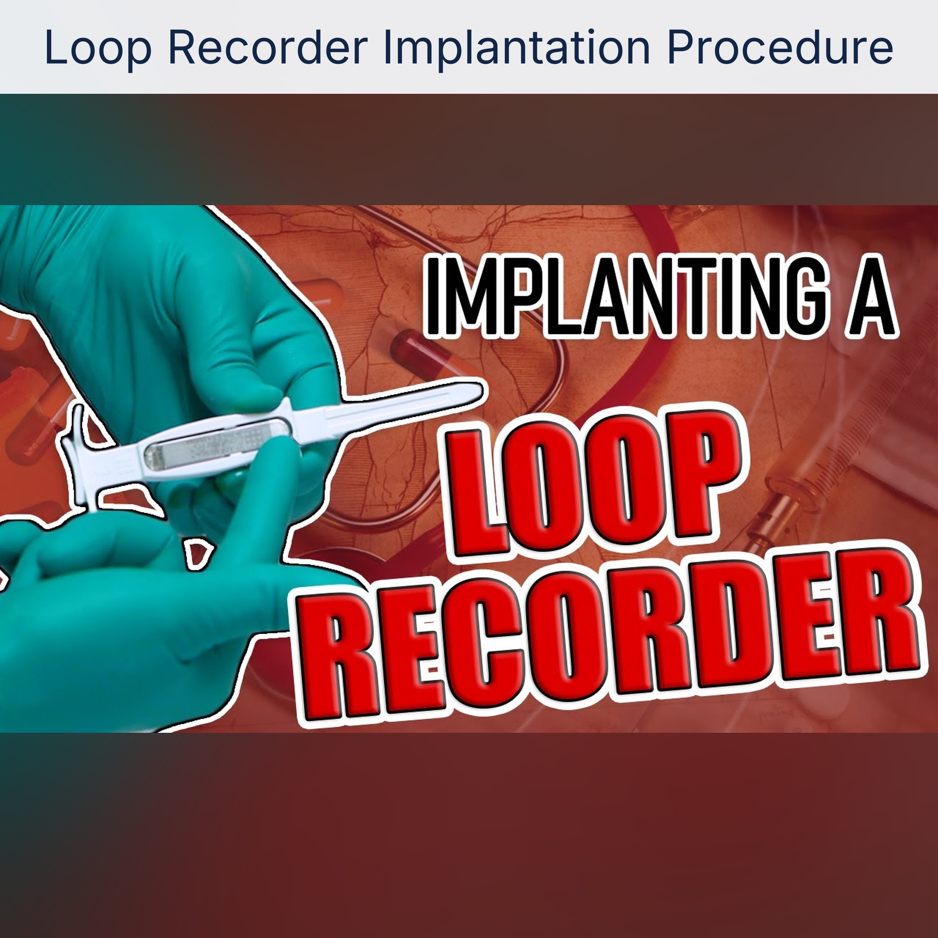 Loop Recorder Implantation Procedure episode artwork