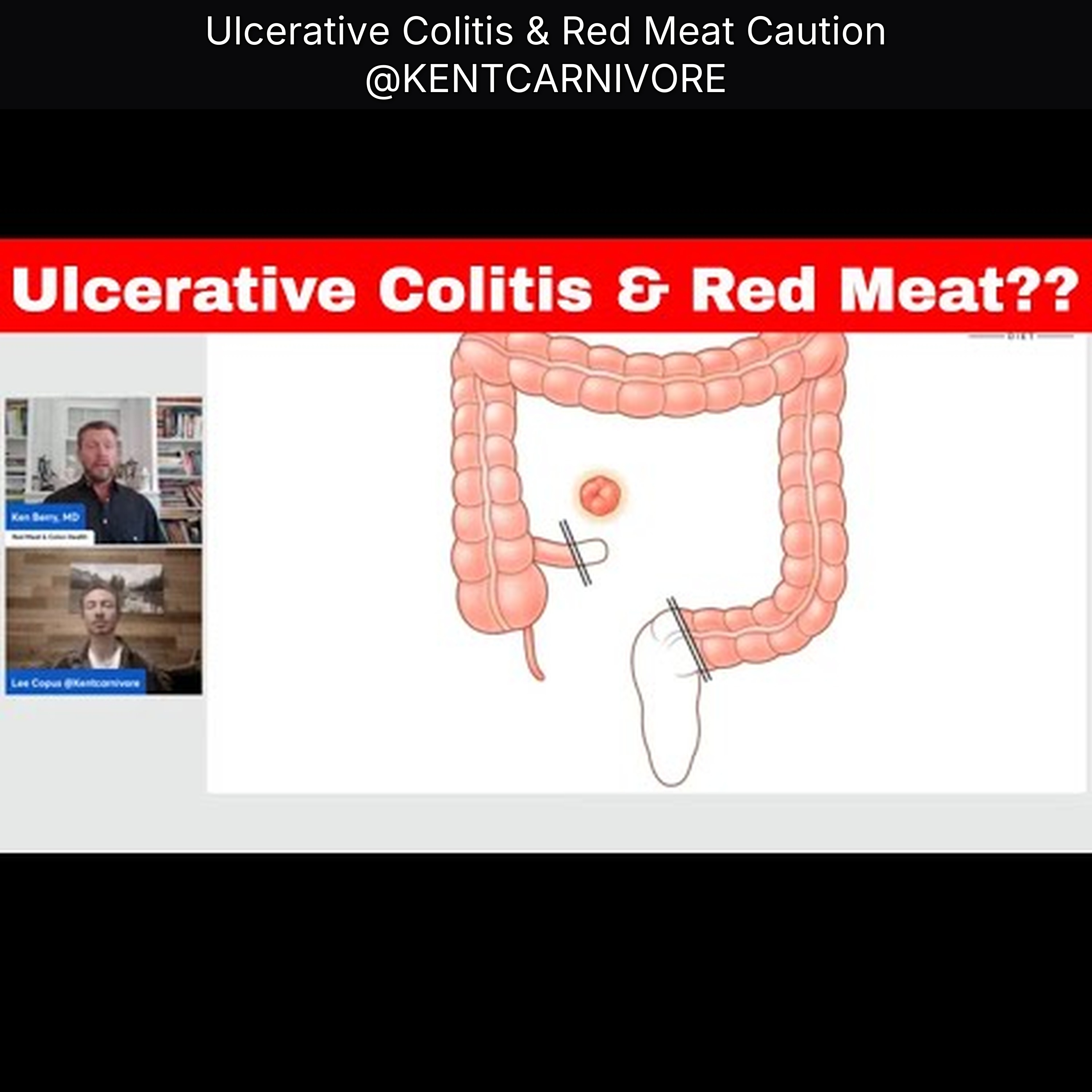 Ulcerative Colitis & Red Meat Caution @KENTCARNIVORE episode artwork