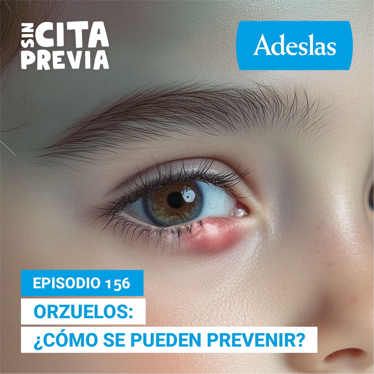 Orzuelos: ¿cómo se pueden prevenir?