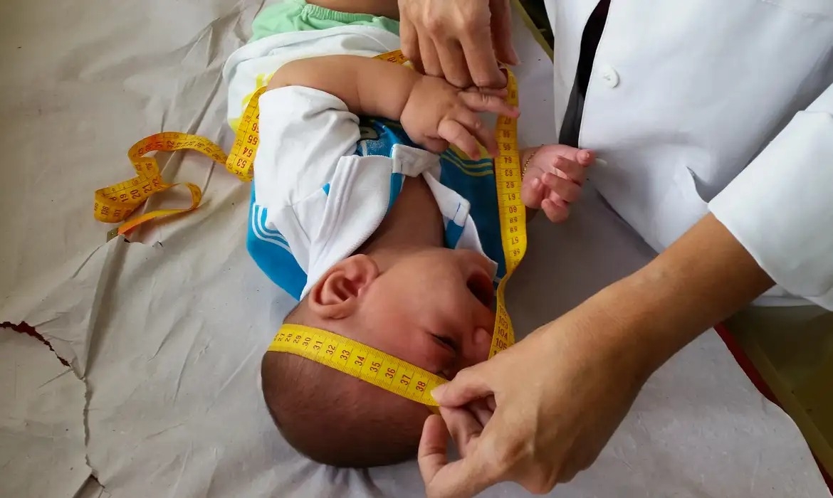 Mais de 20% das crianças com microcefalia por zika vírus apresentaram má-formação após o nascimento, diz estudo