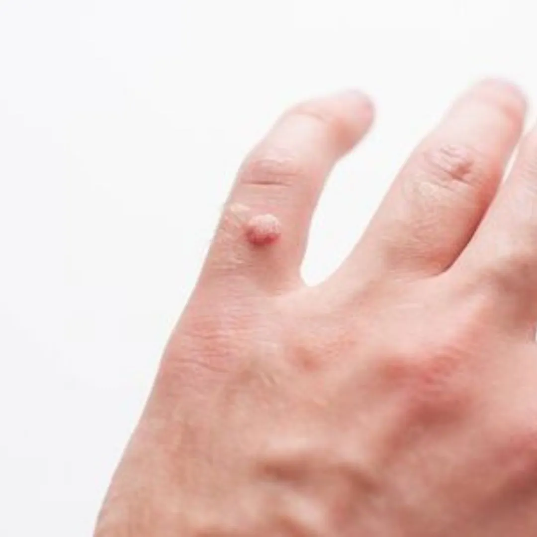 Pourquoi attrape-t-on des verrues ?